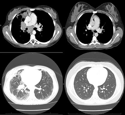 Treatment-Responsive Granulomatous-Lymphocytic Interstitial Lung Disease in a Pediatric Case of Common Variable Immunodeficiency